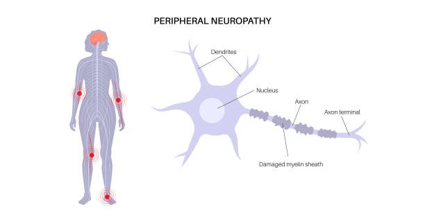 Diabetic Neuropathy